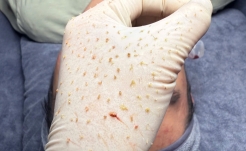 Chăm sóc da mụn chuẩn Y khoa