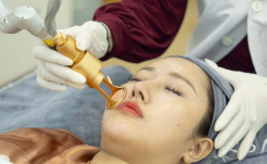 Laser Fractional Tái Sinh Làn Da – Giải Pháp Trẻ Hóa Da An Toàn Tại Xuân Hà Spa