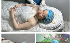 Tiêm B.A.P Profhilo