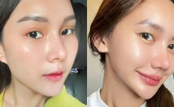 Meso tơ tầm không kim