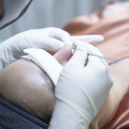 Địa chỉ lấy nhân mụn không sưng Bình Tân